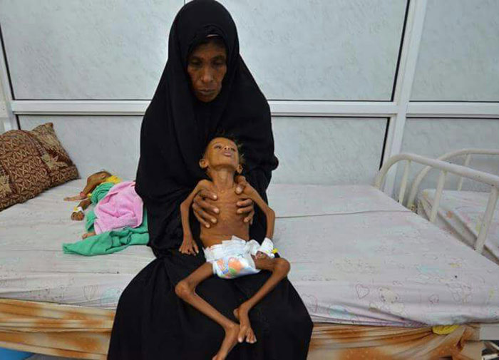 تجاوز نظامی عربستان، مردم یمن را به قحطی کشانید