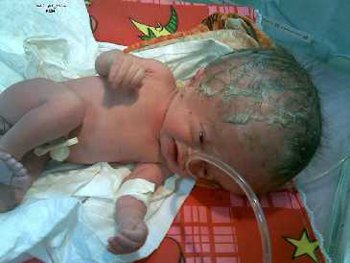 نوزاد ناقصالخلقه در عراق